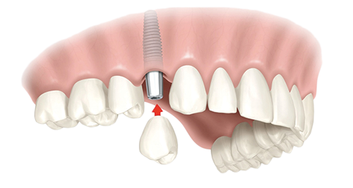 Single Dental Implants Southampton